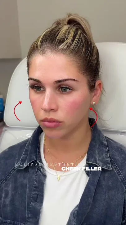 Eclipse AestheticsSI treatment result