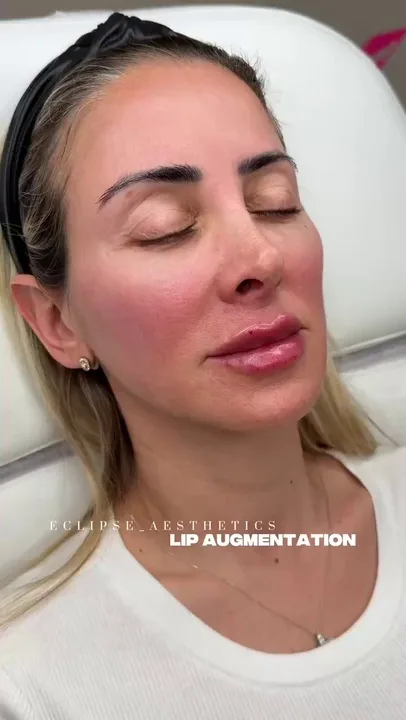 Eclipse AestheticsSI treatment result