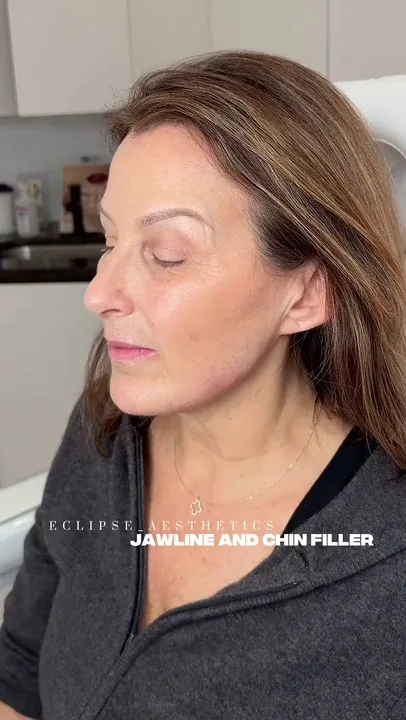 Eclipse AestheticsSI treatment result